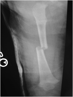 Paediatric Femur Fracture